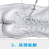 采取局部麻醉方式进行麻醉