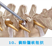 椎间孔镜价格怎么样