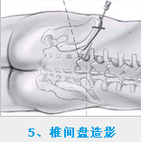 椎间孔镜 王先明