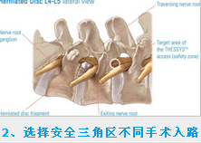 椎间孔镜安全三角区