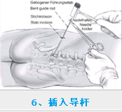 椎间孔镜术后护理