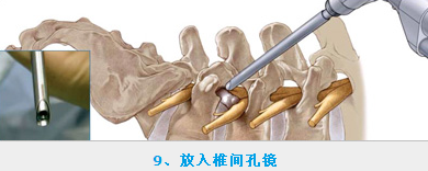 椎间孔镜多少钱