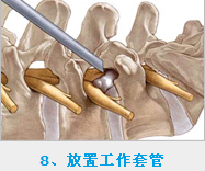 椎间孔镜射频电极