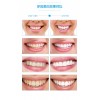 新闻:深圳龙岗冷光美白牙齿的价格一般多少钱,口腔牙齿美白费用